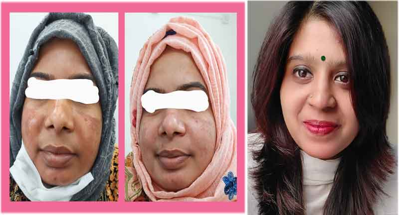 উজ্জ্বল ও দাগহীন ত্বকের জন্য নির্ভরযোগ্য চিকিৎসা পদ্ধতি