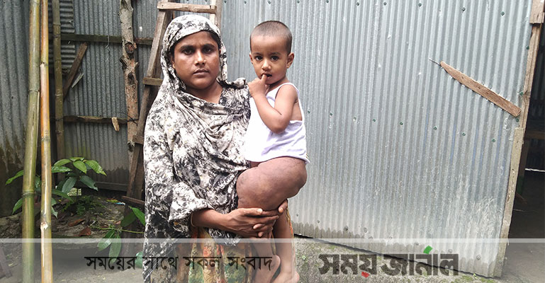 শিশু সাফিনের পুরো শরীরে টিউমার, টাকার অভাবে হচ্ছে না চিকিৎসা