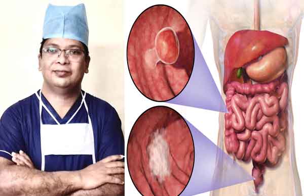 কোলোরেক্টাল ক্যান্সারের লক্ষণ ও প্রতিকারের উপায়