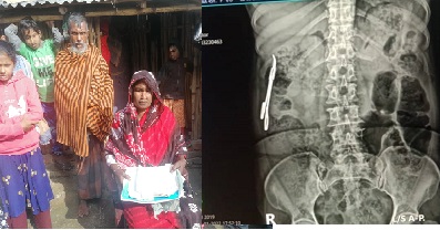 ২০ বছর পর পেটে মিলল অপারেশনের কাঁচি