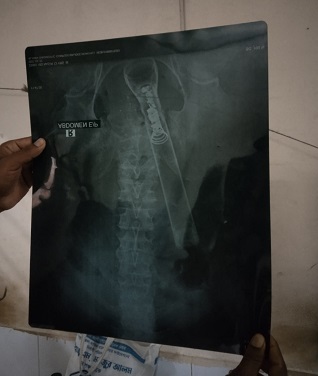 নোয়াখালীতে বৃদ্ধের পায়ু পথে টর্চলাইট চুকিয়ে নির্যাতন