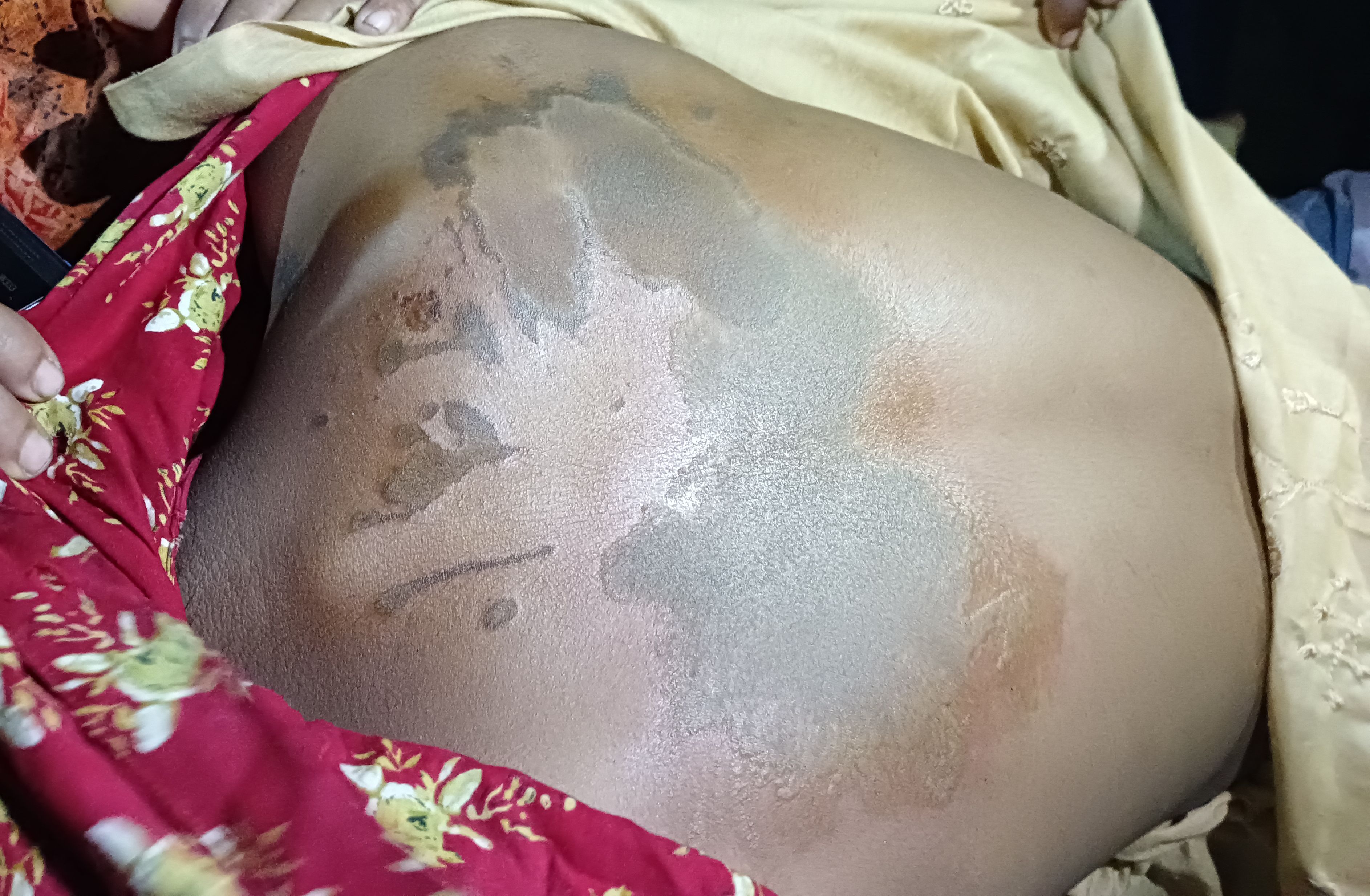 হাতীবান্ধায় পুত্রবধুকে এসিড নিক্ষেপ করল শ্বশুর