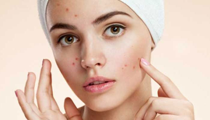 ব্রণ থেকে চিরতরে মুক্তি পাবেন যেভাবে