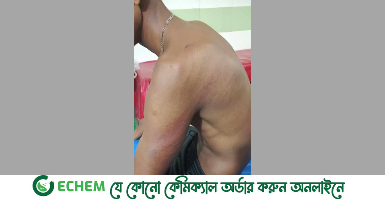 মোরেলগঞ্জে শরীরে ৩২ ক্ষতচিহ্ন নিয়ে হাসপাতালে ভর্তি যুবক