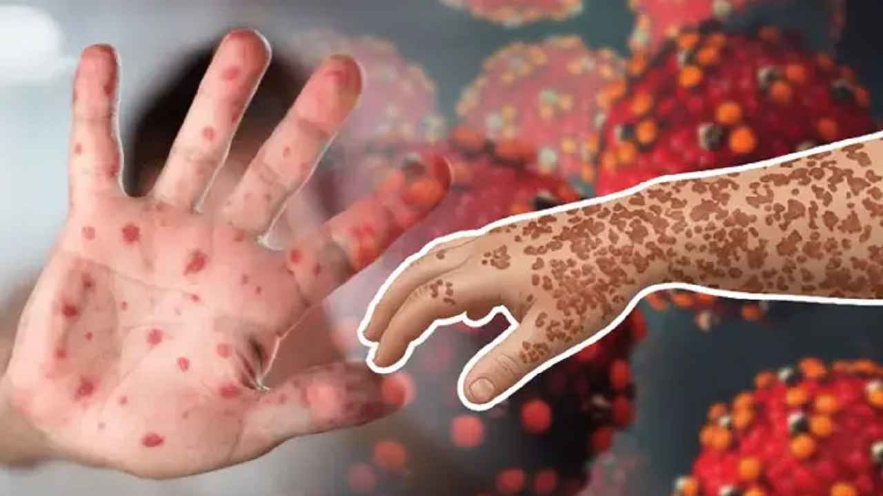 হাম ও উপসর্গ নিয়ে প্রাণ গেল আরও ৯ শিশুর