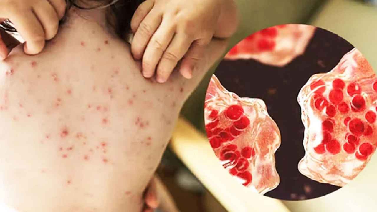 হাম ও উপসর্গ নিয়ে আরও শিশুর মৃত্যু