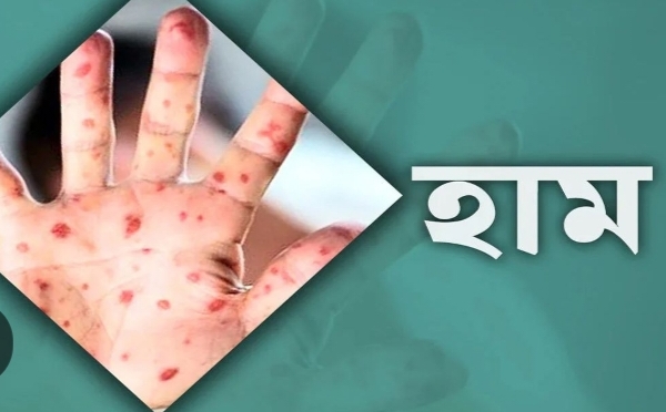 ফরিদপুরে হামের প্রাদুর্ভাব: একদিনে শনাক্ত ৫৪, চার মাসে মৃত্যু ১০