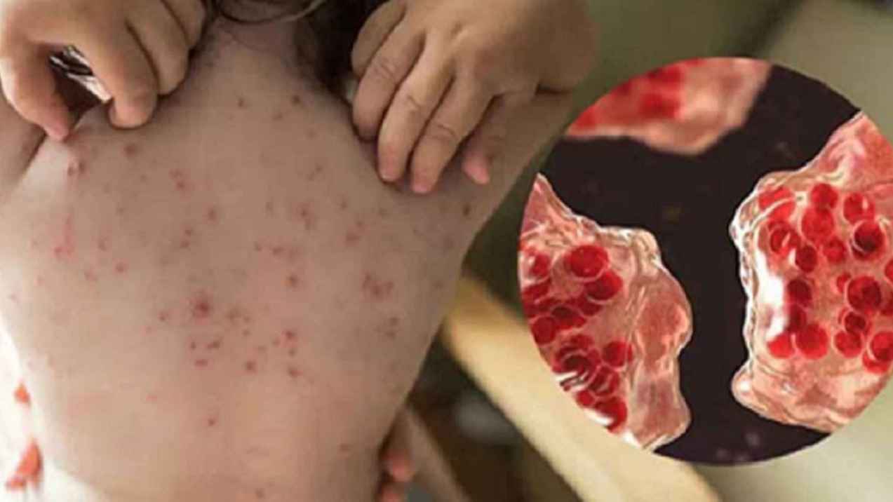 হাম ও উপসর্গে আরও ৯ শিশুর প্রাণহানি