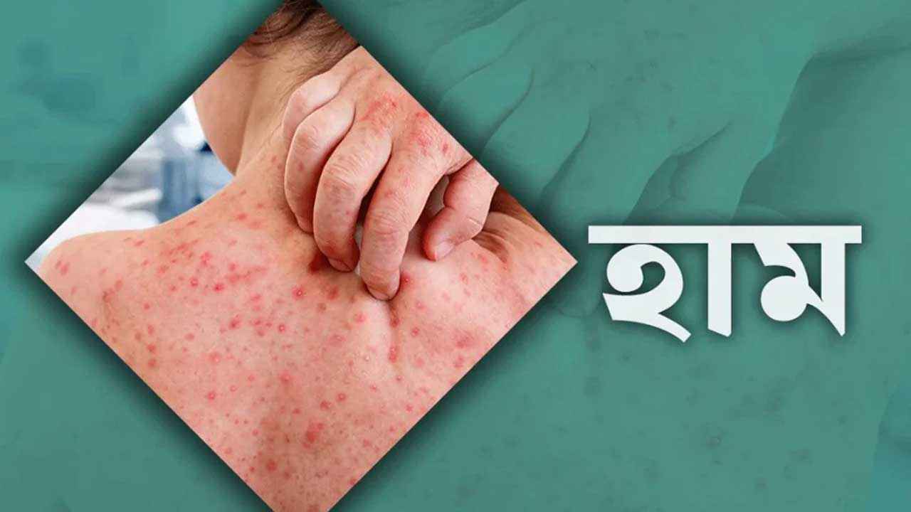 হাম ও উপসর্গে গেল আরও ৯ শিশুর