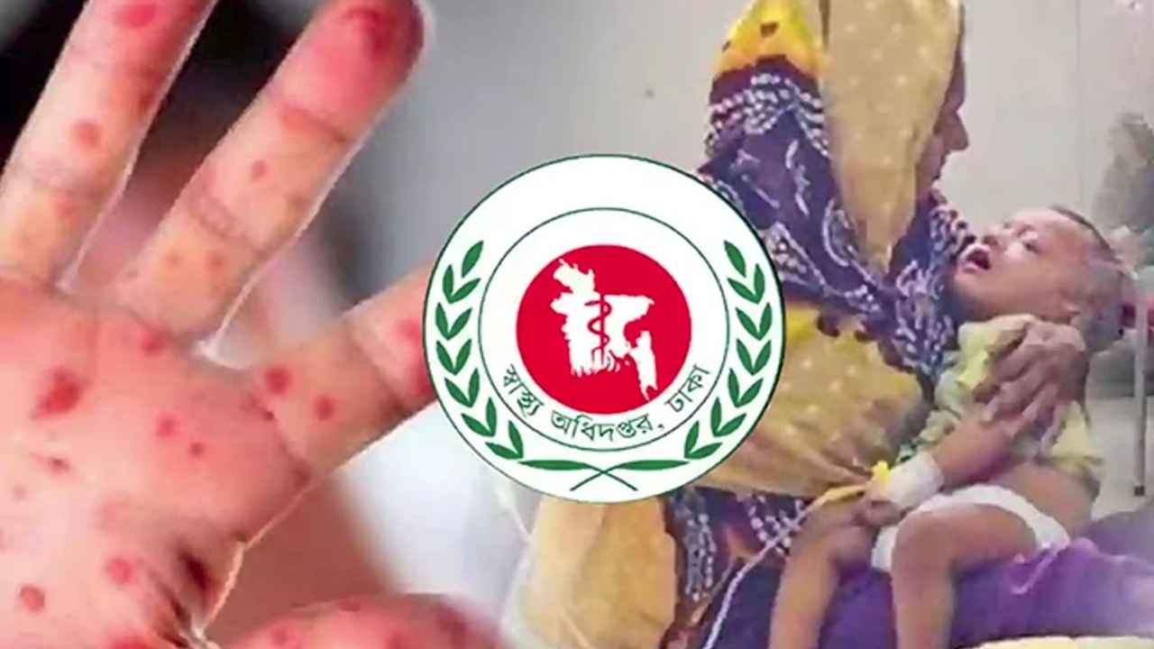 হাম ও উপসর্গে মৃত্যু ৫০০ ছাড়াল